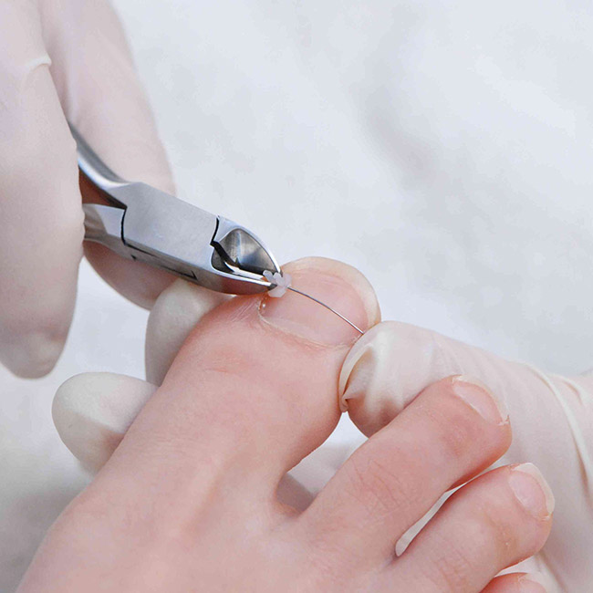 Лечение деформации ногтевой пластины